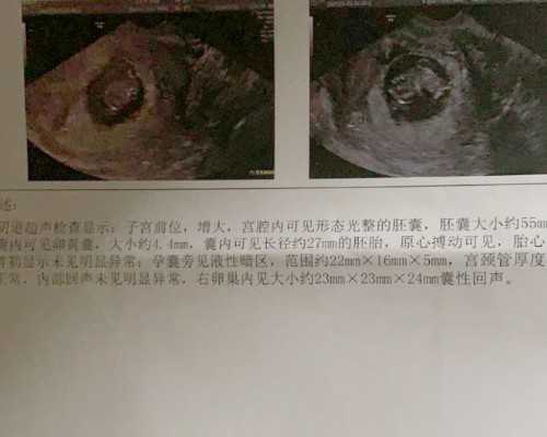 广州助孕公司哪家做的最大|绵阳贫困户诞下双胞胎试管婴儿没奶吃 爱心企业：