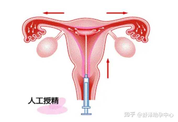 郑州单身女性精子库可以做试管婴儿吗,目前常见的辅助生殖技术总结
